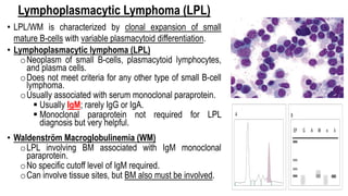 Lymphoplasmacytic Lymphoma (LPL)
• LPL/WM is characterized by clonal expansion of small
mature B-cells with variable plasmacytoid differentiation.
• Lymphoplasmacytic lymphoma (LPL)
oNeoplasm of small B-cells, plasmacytoid lymphocytes,
and plasma cells.
oDoes not meet criteria for any other type of small B-cell
lymphoma.
oUsually associated with serum monoclonal paraprotein.
§ Usually IgM; rarely IgG or IgA.
§ Monoclonal paraprotein not required for LPL
diagnosis but very helpful.
• Waldenström Macroglobulinemia (WM)
oLPL involving BM associated with IgM monoclonal
paraprotein.
oNo specific cutoff level of IgM required.
oCan involve tissue sites, but BM also must be involved.
 