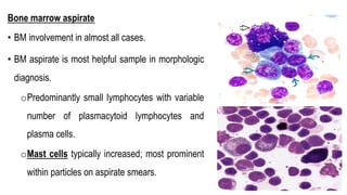 Bone marrow aspirate
• BM involvement in almost all cases.
• BM aspirate is most helpful sample in morphologic
diagnosis.
oPredominantly small lymphocytes with variable
number of plasmacytoid lymphocytes and
plasma cells.
oMast cells typically increased; most prominent
within particles on aspirate smears.
 