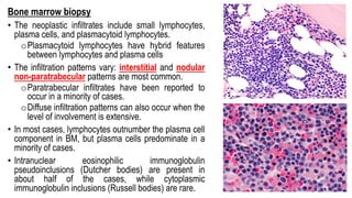 Bone marrow biopsy
• The neoplastic infiltrates include small lymphocytes,
plasma cells, and plasmacytoid lymphocytes.
oPlasmacytoid lymphocytes have hybrid features
between lymphocytes and plasma cells
• The infiltration patterns vary: interstitial and nodular
non-paratrabecular patterns are most common.
oParatrabecular infiltrates have been reported to
occur in a minority of cases.
oDiffuse infiltration patterns can also occur when the
level of involvement is extensive.
• In most cases, lymphocytes outnumber the plasma cell
component in BM, but plasma cells predominate in a
minority of cases.
• Intranuclear eosinophilic immunoglobulin
pseudoinclusions (Dutcher bodies) are present in
about half of the cases, while cytoplasmic
immunoglobulin inclusions (Russell bodies) are rare.
 