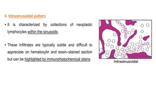 4. Intrasinusoidal pattern
• It is characterized by collections of neoplastic
lymphocytes within the sinusoids.
• These infiltrates are typically subtle and difficult to
appreciate on hematoxylin and eosin–stained section
but can be highlighted by immunohistochemical stains.
 