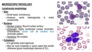MICROSCOPIC PATHOLOGY
Lymphocyte morphology:
• Size:
oSmall sized, monotonous.
oHowever, some heterogeneity is noted
occasionally.
• Nucleus:
oNuclear contour: Round nuclear contour
oChromatin: Highly condensed nuclear chromatin.
Characteristic soccer ball or cracked mud
chromatin pattern.
oNucleolus: No nucleoli.
• Cytoplasm:
oIt is generally scant agranular.
oMay be more moderate in some cases that exhibit
otherwise typical morphologic features of CLL.
 