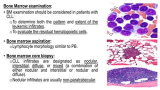 Bone Marrow examination:
• BM examination should be considered in patients with
CLL:
oTo determine both the pattern and extent of the
leukemic infiltrates.
oTo evaluate the residual hematopoietic cells.
• Bone marrow aspiration:
oLymphocyte morphology similar to PB.
• Bone marrow core biopsy:
oCLL infiltrates are designated as nodular,
interstitial, diffuse, or mixed (a combination of
either nodular and interstitial or nodular and
diffuse).
oNodular infiltrates are usually non-paratrabecular.
 