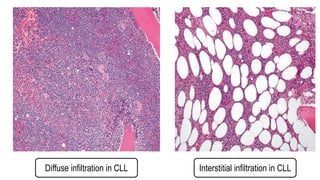Diffuse infiltration in CLL Interstitial infiltration in CLL
 