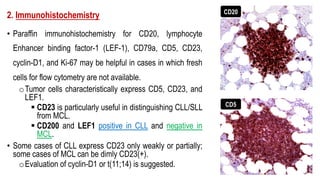 2. Immunohistochemistry
• Paraffin immunohistochemistry for CD20, lymphocyte
Enhancer binding factor-1 (LEF-1), CD79a, CD5, CD23,
cyclin-D1, and Ki-67 may be helpful in cases in which fresh
cells for flow cytometry are not available.
oTumor cells characteristically express CD5, CD23, and
LEF1.
§ CD23 is particularly useful in distinguishing CLL/SLL
from MCL.
§ CD200 and LEF1 positive in CLL and negative in
MCL.
• Some cases of CLL express CD23 only weakly or partially;
some cases of MCL can be dimly CD23(+).
oEvaluation of cyclin-D1 or t(11;14) is suggested.
CD20
CD5
 