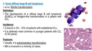 2. Overt diffuse large B-cell lymphoma
• a.k.a. Richter transformation.
Definition:
• The development of a diffuse large B cell lymphoma
(DLBCL) or Hodgkin-like transformation in a patient with
CLL.
Incidence:
• It occurs in 2% - 12% of patients with established CLL.
• It is relatively more common in younger patients with CLL
(≤ 55 years).
Features:
• Usually, it is extramedullary transformation.
• BM is involved in a minority of cases.
 