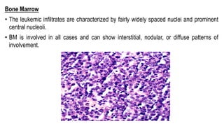 Bone Marrow
• The leukemic infiltrates are characterized by fairly widely spaced nuclei and prominent
central nucleoli.
• BM is involved in all cases and can show interstitial, nodular, or diffuse patterns of
involvement.
 