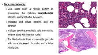 • Bone marrow biopsy
oMost cases show a nodular pattern of
involvement that includes paratrabecular
infiltrates in almost half of the cases.
oInterstitial and diffuse patterns also are
common
oIn biopsy sections, neoplastic cells are small to
medium sized with irregular nuclei.
oThe blastoid variant has somewhat larger cells
with more dispersed chromatin and a brisk
mitotic rate.
 