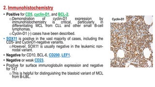 2. Immunohistochemistry
• Positive for CD5, cyclin-D1, and BCL-2.
oDemonstration of cyclin-D1 expression by
immunohistochemistry is critical, particularly in
differentiating MCL from CLL and other small B-cell
lymphomas.
oCyclin-D1 (-) cases have been described.
• SOX11 is positive in the vast majority of cases, including the
CD5- and CyclinD1-negative variants.
oHowever, SOX11 is usually negative in the leukemic non-
nodal variant.
• Negative for CD10, BCL-6, CD200, LEF1.
• Negative or weak CD23.
• Positive for surface immunoglobulin expression and negative
for TdT
oThis is helpful for distinguishing the blastoid variant of MCL
from B-LBL.
Cyclin-D1
 