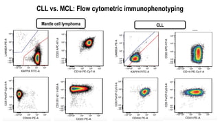 Mantle cell lymphoma CLL
CLL vs. MCL: Flow cytometric immunophenotyping
 