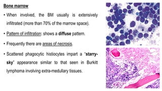 Bone marrow
• When involved, the BM usually is extensively
infiltrated (more than 70% of the marrow space).
• Pattern of infiltration: shows a diffuse pattern.
• Frequently there are areas of necrosis.
• Scattered phagocytic histiocytes impart a “starry-
sky” appearance similar to that seen in Burkitt
lymphoma involving extra-medullary tissues.
 