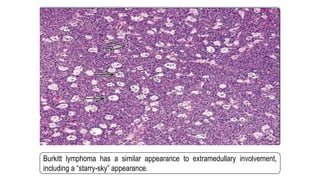 Burkitt lymphoma has a similar appearance to extramedullary involvement,
including a “starry-sky” appearance.
 