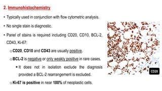 2. Immunohistochemistry
• Typically used in conjunction with flow cytometric analysis.
• No single stain is diagnostic.
• Panel of stains is required including CD20, CD10, BCL-2,
CD43, Ki-67:
oCD20, CD10 and CD43 are usually positive.
oBCL-2 is negative or only weakly positive in rare cases.
§ It does not in isolation exclude the diagnosis
provided a BCL-2 rearrangement is excluded.
oKi-67 is positive in near 100% of neoplastic cells.
CD20
 