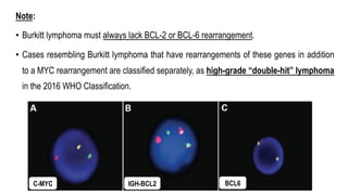 Note:
• Burkitt lymphoma must always lack BCL-2 or BCL-6 rearrangement.
• Cases resembling Burkitt lymphoma that have rearrangements of these genes in addition
to a MYC rearrangement are classified separately, as high-grade “double-hit” lymphoma
in the 2016 WHO Classification.
C-MYC IGH-BCL2 BCL6
 