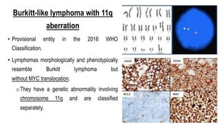 Burkitt-like lymphoma with 11q
aberration
• Provisional entity in the 2016 WHO
Classification.
• Lymphomas morphologically and phenotypically
resemble Burkitt lymphoma but
without MYC translocation.
oThey have a genetic abnormality involving
chromosome 11q and are classified
separately.
 