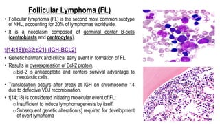 Follicular Lymphoma (FL)
• Follicular lymphoma (FL) is the second most common subtype
of NHL, accounting for 20% of lymphomas worldwide.
• It is a neoplasm composed of germinal center B-cells
(centroblasts and centrocytes).
t(14;18)(q32;q21) (IGH-BCL2)
• Genetic hallmark and critical early event in formation of FL.
• Results in overexpression of Bcl-2 protein.
oBcl-2 is antiapoptotic and confers survival advantage to
neoplastic cells.
• Translocation occurs after break at IGH on chromosome 14
due to defective VDJ recombination.
• t(14;18) is considered initiating molecular event of FL:
oInsufficient to induce lymphomagenesis by itself.
oSubsequent genetic alteration(s) required for development
of overt lymphoma
 