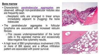 Bone marrow
• Characteristic paratrabecular aggregates are
observed, although non-paratrabecular nodules also
are frequently seen.
oNeoplastic cells are arranged in linear arrays
immediately adjacent to (hugging) the bone
trabeculae
• The paratrabecular aggregates in follicular
lymphoma are associated with increased reticulin
fibrosis.
oThis causes underrepresentation of the tumor
cells in the aspirated marrow and occasionally
false-negative flow cytometry results.
• A high level of BM lymphomatous involvement (10%
or more of BM space) and a diffuse infiltration
pattern are associated with poorer survival.
 