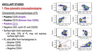 ANCILLARY STUDIES
1. Flow cytometric immunophenotyping
Characteristic immunophenotype of FL
• Positive CD20 (bright).
• Positive CD19 (Dimmer than CD20).
• Positive CD10.
• Negative CD5, cyclin D1 and CD200.
• Surface light chain expression.
oOf note, 10% of FL may not express
surface light chain.
• FL cells differ from hematogones in:
oBrighter CD45.
oDimmer CD38.
oNegative CD43.
 
