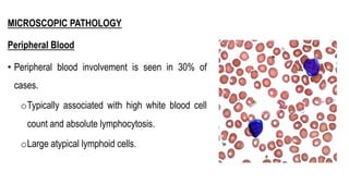 MICROSCOPIC PATHOLOGY
Peripheral Blood
• Peripheral blood involvement is seen in 30% of
cases.
oTypically associated with high white blood cell
count and absolute lymphocytosis.
oLarge atypical lymphoid cells.
 