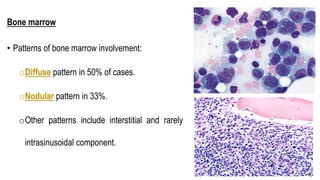 Bone marrow
• Patterns of bone marrow involvement:
oDiffuse pattern in 50% of cases.
oNodular pattern in 33%.
oOther patterns include interstitial and rarely
intrasinusoidal component.
 