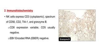 2. Immunohistochemistry
• NK cells express CD3 (cytoplasmic), spectrum
of CD56, CD2, TIA-1, and granzyme B.
oCD8 expression variable; CD5 usually
negative.
oEBV Encoded RNA (EBER) negative. Granzyme B
 