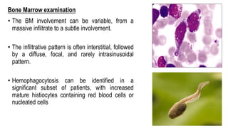 Bone Marrow examination
• The BM involvement can be variable, from a
massive infiltrate to a subtle involvement.
• The infiltrative pattern is often interstitial, followed
by a diffuse, focal, and rarely intrasinusoidal
pattern.
• Hemophagocytosis can be identified in a
significant subset of patients, with increased
mature histiocytes containing red blood cells or
nucleated cells
 