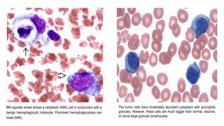 BM aspirate smear shows a neoplastic ANKL cell in conjunction with a
benign hemophagocytic histiocyte. Prominent hemophagocytosis can
mask ANKL.
The tumor cells have moderately abundant cytoplasm with azurophilic
granules. However, these cells are much bigger than normal, reactive,
or clonal large granular lymphocytes
 