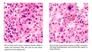 BM core biopsy section shows a substantial interstitial infiltrate of
variably sized pleomorphic ANKL cells. Note the large tadpole
appearance of some neoplastic cells.
BM core biopsy shows extensive infiltration by ANKL in conjunction
with benign hemophagocytosis. Note prominent RBC ingestion by
benign histiocytes.
 