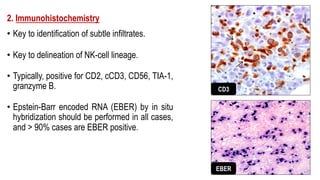 2. Immunohistochemistry
• Key to identification of subtle infiltrates.
• Key to delineation of NK-cell lineage.
• Typically, positive for CD2, cCD3, CD56, TIA-1,
granzyme B.
• Epstein-Barr encoded RNA (EBER) by in situ
hybridization should be performed in all cases,
and > 90% cases are EBER positive.
CD3
EBER
 