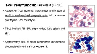 T-cell Prolymphocytic Leukemia (T-PLL)
• Aggressive T-cell leukemia characterized proliferation of
small to medium-sized prolymphocytes with a mature
post-thymic T-cell phenotype.
• T-PLL involves PB, BM, lymph nodes, liver, spleen and
skin.
• Approximately 90% of cases demonstrate chromosome
abnormalities involving chromosome 14.
 