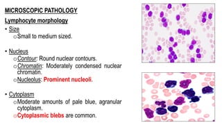 MICROSCOPIC PATHOLOGY
Lymphocyte morphology
• Size
oSmall to medium sized.
• Nucleus
oContour: Round nuclear contours.
oChromatin: Moderately condensed nuclear
chromatin.
oNucleolus: Prominent nucleoli.
• Cytoplasm
oModerate amounts of pale blue, agranular
cytoplasm.
oCytoplasmic blebs are common.
 