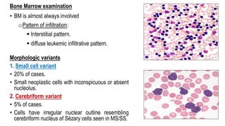 Bone Marrow examination
• BM is almost always involved
oPattern of infiltration:
§ Interstitial pattern.
§ diffuse leukemic infiltrative pattern.
Morphologic variants
1. Small cell variant
• 20% of cases.
• Small neoplastic cells with inconspicuous or absent
nucleolus.
2. Cerebriform variant
• 5% of cases.
• Cells have irregular nuclear outline resembling
cerebriform nucleus of Sézary cells seen in MS/SS.
 