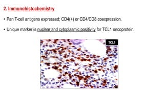 2. Immunohistochemistry
• Pan T-cell antigens expressed; CD4(+) or CD4/CD8 coexpression.
• Unique marker is nuclear and cytoplasmic positivity for TCL1 oncoprotein.
TCL1
 