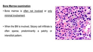 Bone Marrow examination
• Bone marrow is often not involved or only
minimal involvement.
• When the BM is involved, Sézary cell infiltrate is
often sparse, predominantly a patchy or
interstitial pattern.
 