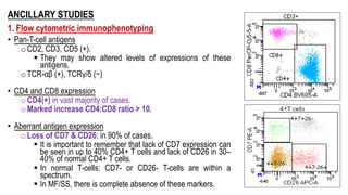 ANCILLARY STUDIES
1. Flow cytometric immunophenotyping
• Pan-T-cell antigens
o CD2, CD3, CD5 (+).
§ They may show altered levels of expressions of these
antigens.
o TCR-αβ (+), TCRγ/δ (−)
• CD4 and CD8 expression
o CD4(+) in vast majority of cases.
o Marked increase CD4:CD8 ratio > 10.
• Aberrant antigen expression
o Loss of CD7 & CD26: in 90% of cases.
§ It is important to remember that lack of CD7 expression can
be seen in up to 40% CD4+ T cells and lack of CD26 in 30–
40% of normal CD4+ T cells.
§ In normal T-cells: CD7- or CD26- T-cells are within a
spectrum.
§ In MF/SS, there is complete absence of these markers.
 
