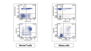 Normal T-cells Sézary cells
 