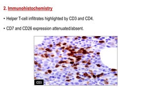 2. Immunohistochemistry
• Helper T-cell infiltrates highlighted by CD3 and CD4.
• CD7 and CD26 expression attenuated/absent.
CD3
 