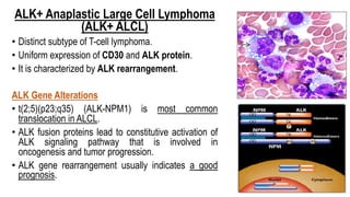 ALK+ Anaplastic Large Cell Lymphoma
(ALK+ ALCL)
• Distinct subtype of T-cell lymphoma.
• Uniform expression of CD30 and ALK protein.
• It is characterized by ALK rearrangement.
ALK Gene Alterations
• t(2;5)(p23;q35) (ALK-NPM1) is most common
translocation in ALCL.
• ALK fusion proteins lead to constitutive activation of
ALK signaling pathway that is involved in
oncogenesis and tumor progression.
• ALK gene rearrangement usually indicates a good
prognosis.
 