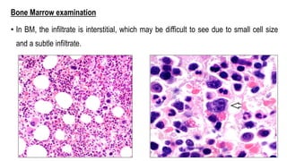 Bone Marrow examination
• In BM, the infiltrate is interstitial, which may be difficult to see due to small cell size
and a subtle infiltrate.
 