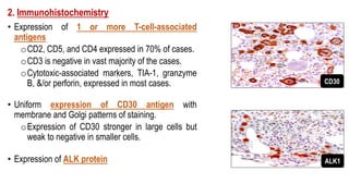 2. Immunohistochemistry
• Expression of 1 or more T-cell-associated
antigens
oCD2, CD5, and CD4 expressed in 70% of cases.
oCD3 is negative in vast majority of the cases.
oCytotoxic-associated markers, TIA-1, granzyme
B, &/or perforin, expressed in most cases.
• Uniform expression of CD30 antigen with
membrane and Golgi patterns of staining.
oExpression of CD30 stronger in large cells but
weak to negative in smaller cells.
• Expression of ALK protein
CD30
ALK1
 