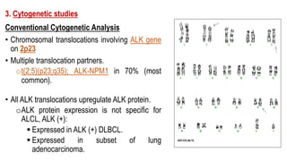 3. Cytogenetic studies
Conventional Cytogenetic Analysis
• Chromosomal translocations involving ALK gene
on 2p23
• Multiple translocation partners.
ot(2;5)(p23;q35); ALK-NPM1 in 70% (most
common).
• All ALK translocations upregulate ALK protein.
oALK protein expression is not specific for
ALCL, ALK (+):
§ Expressed in ALK (+) DLBCL.
§ Expressed in subset of lung
adenocarcinoma.
 