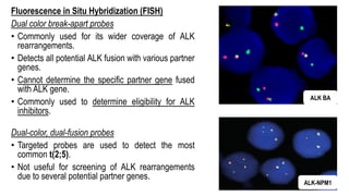 Fluorescence in Situ Hybridization (FISH)
Dual color break-apart probes
• Commonly used for its wider coverage of ALK
rearrangements.
• Detects all potential ALK fusion with various partner
genes.
• Cannot determine the specific partner gene fused
with ALK gene.
• Commonly used to determine eligibility for ALK
inhibitors.
Dual-color, dual-fusion probes
• Targeted probes are used to detect the most
common t(2;5).
• Not useful for screening of ALK rearrangements
due to several potential partner genes.
ALK BA
ALK-NPM1
 