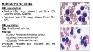 MICROSCOPIC PATHOLOGY
LGL lymphocytosis
• Absolute LGLs range between 2 and 20 x 10⁹/L
(according to WHO guideline).
• Occasional cases LGLs range between 0.5 and 10 x
10⁹/L.
LGL morphology
Size: Small to medium in size.
Nucleus:
oContour: Round/slightly indented contour.
oNucleolus: Inconspicuous nucleoli.
oChromatin: Condensed chromatin.
Cytoplasm: Abundant pale cytoplasm, and fine
azurophilic granules.
 