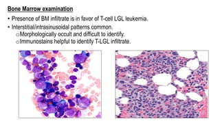 Bone Marrow examination
• Presence of BM infiltrate is in favor of T-cell LGL leukemia.
• Interstitial/intrasinusoidal patterns common.
oMorphologically occult and difficult to identify.
oImmunostains helpful to identify T-LGL infiltrate.
 
