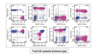 T-cell LGL leukemia (Common type)
 