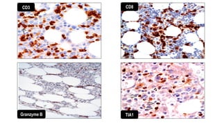 TIA1
CD8
CD3
Granzyme B
 