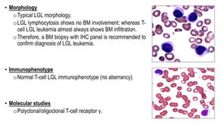 • Morphology
oTypical LGL morphology.
oLGL lymphocytosis shows no BM involvement; whereas T-
cell LGL leukemia almost always shows BM infiltration.
oTherefore, a BM biopsy with IHC panel is recommended to
confirm diagnosis of LGL leukemia.
• Immunophenotype
oNormal T-cell LGL immunophenotype (no aberrancy).
• Molecular studies
oPolyclonal/oligoclonal T-cell receptor γ.
 