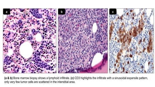 (a & b) Bone marrow biopsy shows a lymphoid infiltrate. (c) CD3 highlights the infiltrate with a sinusoidal expansile pattern,
only very few tumor cells are scattered in the interstitial area.
a b c
 