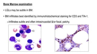 Bone Marrow examination
• LGLs may be subtle in BM.
• BM infiltrates best identified by immunohistochemical staining for CD3 and TIA-1.
oInfiltrates subtle and often intrasinusoidal &/or focal, patchy.
 