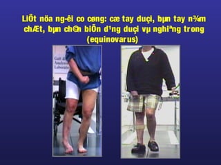 LiÖt nöa ng­êi co cøng: cæ tay duçi, bµn tay n¾m
chÆt, bµn ch©n biÕn d¹ng duçi vµ nghiªng trong
(equinovarus)
 