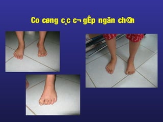 Co cøng c¸c c¬ gÊp ngãn ch©n
 